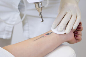 a person in a process of laser tattoo removal options in Adelaide.